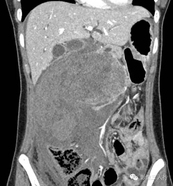 胰腺实性假乳头状瘤Solid Pseudopaillary Neoplasm 胰腺实性假乳头状瘤Solid Pseudopaillary Neoplasm