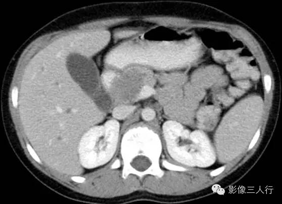 胰腺实性假乳头状瘤Solid Pseudopaillary Neoplasm 胰腺实性假乳头状瘤Solid Pseudopaillary Neoplasm
