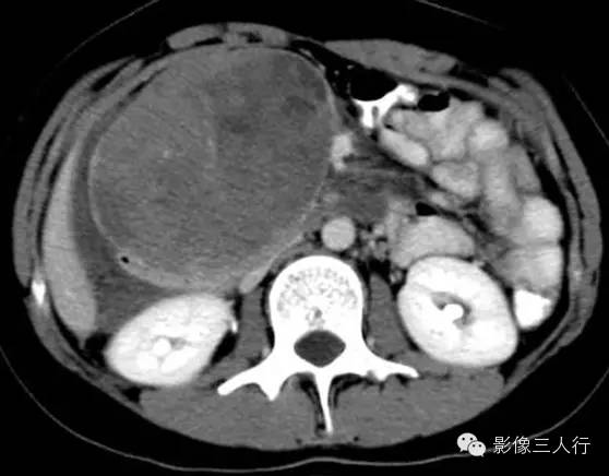 胰腺实性假乳头状瘤Solid Pseudopaillary Neoplasm 胰腺实性假乳头状瘤Solid Pseudopaillary Neoplasm
