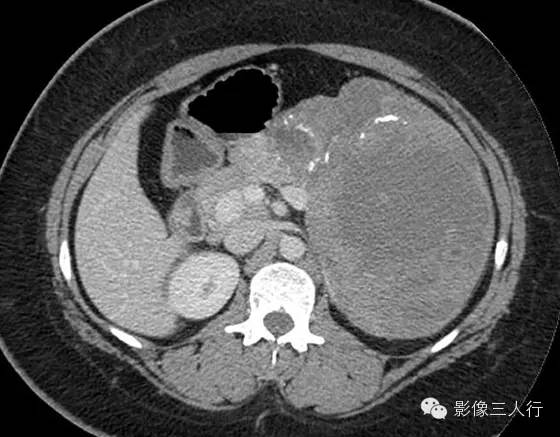 胰腺实性假乳头状瘤Solid Pseudopaillary Neoplasm 胰腺实性假乳头状瘤Solid Pseudopaillary Neoplasm
