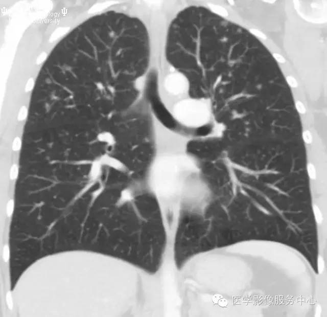 【病例】肺郎格汉斯细胞组织细胞增生症1例CT影像特点 【病例】肺郎格汉斯细胞组织细胞增生症1例CT影像特点