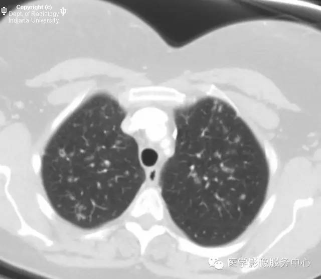 【病例】肺郎格汉斯细胞组织细胞增生症1例CT影像特点