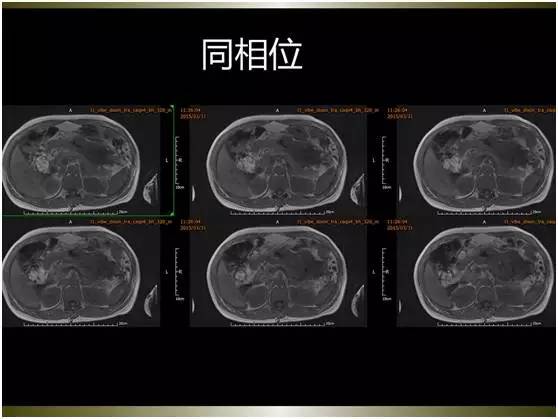 【病例】腹膜恶性间皮瘤1例MR影像表现 【病例】腹膜恶性间皮瘤1例MR影像表现