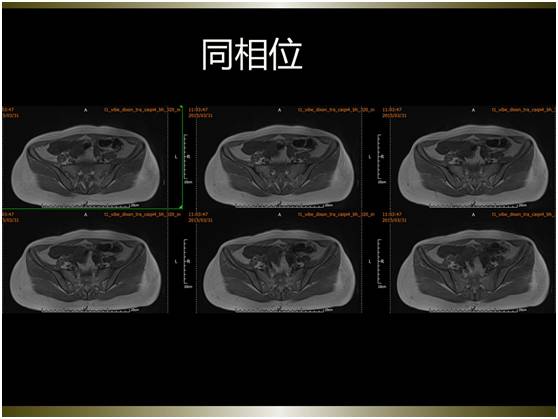【病例】腹膜恶性间皮瘤1例MR影像表现 【病例】腹膜恶性间皮瘤1例MR影像表现
