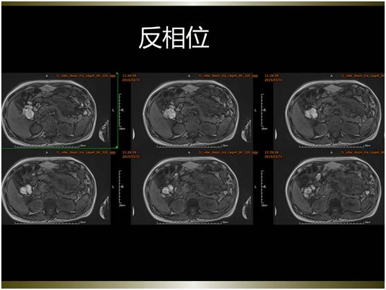【病例】腹膜恶性间皮瘤1例MR影像表现 【病例】腹膜恶性间皮瘤1例MR影像表现