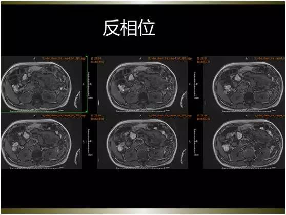 【病例】腹膜恶性间皮瘤1例MR影像表现 【病例】腹膜恶性间皮瘤1例MR影像表现