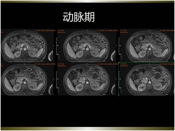 【病例】腹膜恶性间皮瘤1例MR影像表现 【病例】腹膜恶性间皮瘤1例MR影像表现