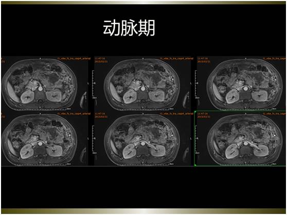 【病例】腹膜恶性间皮瘤1例MR影像表现 【病例】腹膜恶性间皮瘤1例MR影像表现