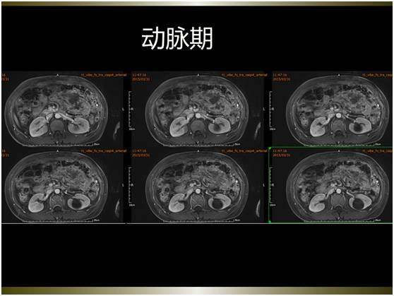 【病例】腹膜恶性间皮瘤1例MR影像表现 【病例】腹膜恶性间皮瘤1例MR影像表现
