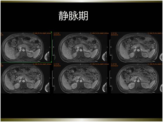 【病例】腹膜恶性间皮瘤1例MR影像表现 【病例】腹膜恶性间皮瘤1例MR影像表现