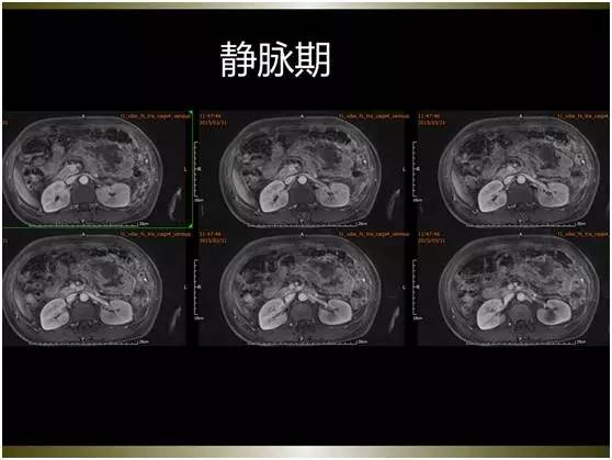 【病例】腹膜恶性间皮瘤1例MR影像表现 【病例】腹膜恶性间皮瘤1例MR影像表现