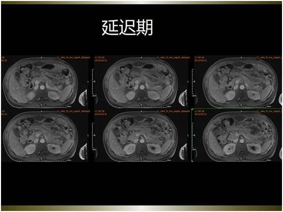 【病例】腹膜恶性间皮瘤1例MR影像表现 【病例】腹膜恶性间皮瘤1例MR影像表现