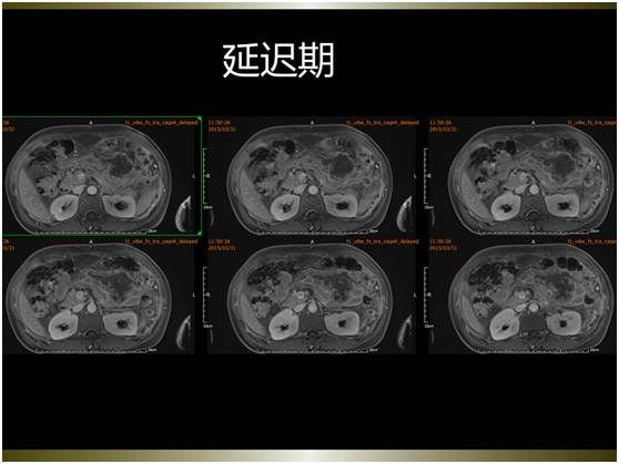 【病例】腹膜恶性间皮瘤1例MR影像表现 【病例】腹膜恶性间皮瘤1例MR影像表现