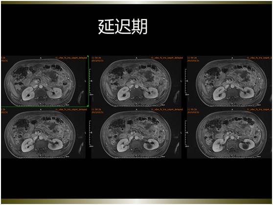 【病例】腹膜恶性间皮瘤1例MR影像表现 【病例】腹膜恶性间皮瘤1例MR影像表现