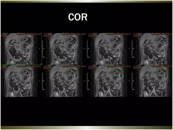 【病例】腹膜恶性间皮瘤1例MR影像表现 【病例】腹膜恶性间皮瘤1例MR影像表现