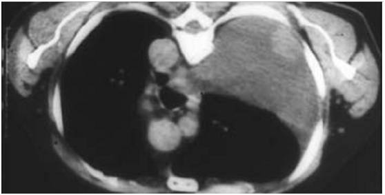 【病例】腹膜恶性间皮瘤1例MR影像表现 【病例】腹膜恶性间皮瘤1例MR影像表现