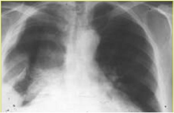 【病例】腹膜恶性间皮瘤1例MR影像表现 【病例】腹膜恶性间皮瘤1例MR影像表现