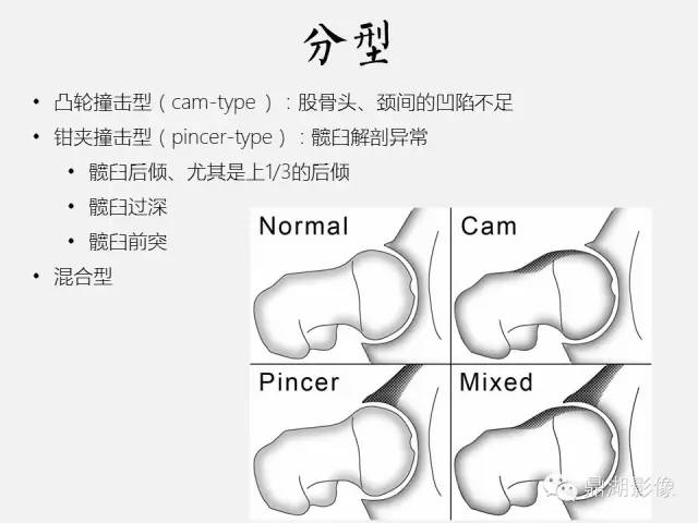 【PPT】髋关节撞击综合症