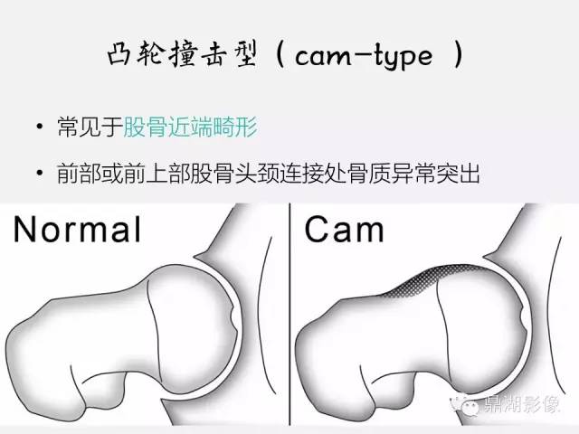 【PPT】髋关节撞击综合症