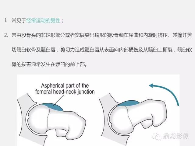 【PPT】髋关节撞击综合症