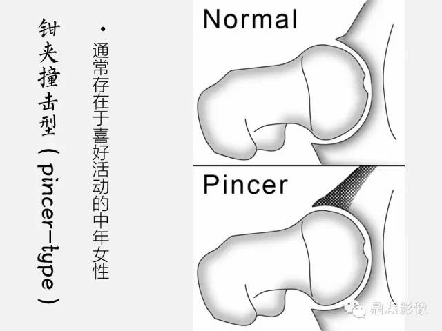 【PPT】髋关节撞击综合症
