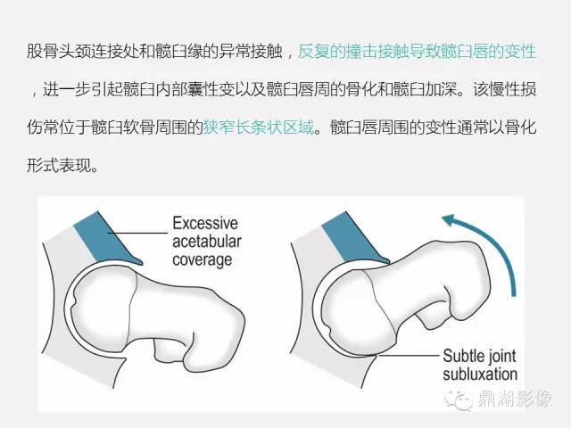 【PPT】髋关节撞击综合症