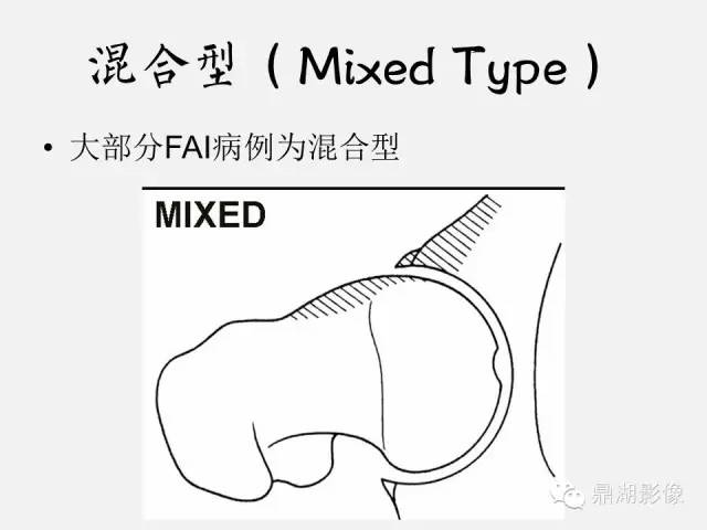 【PPT】髋关节撞击综合症