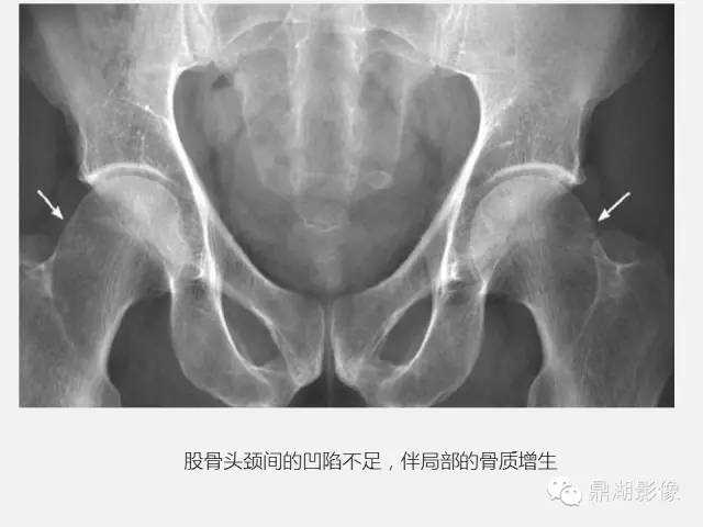 【PPT】髋关节撞击综合症