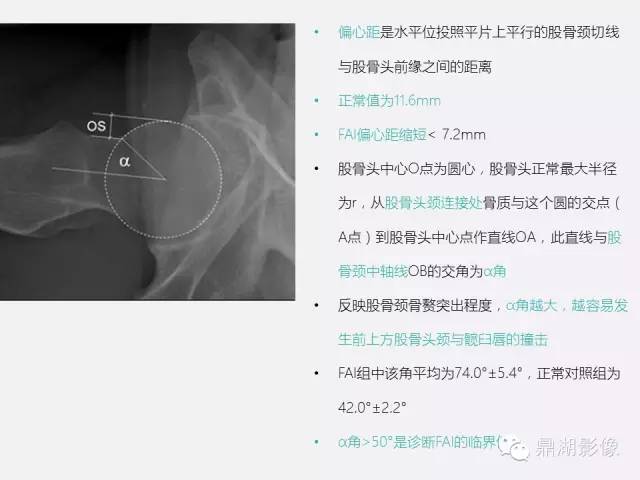 【PPT】髋关节撞击综合症