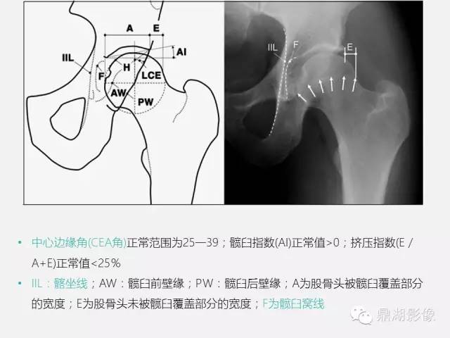 【PPT】髋关节撞击综合症