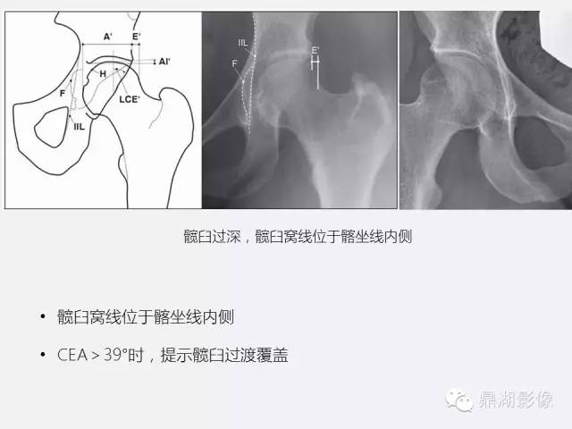【PPT】髋关节撞击综合症