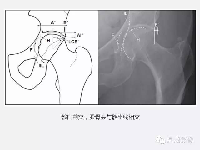 【PPT】髋关节撞击综合症