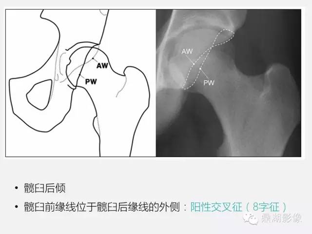 【PPT】髋关节撞击综合症