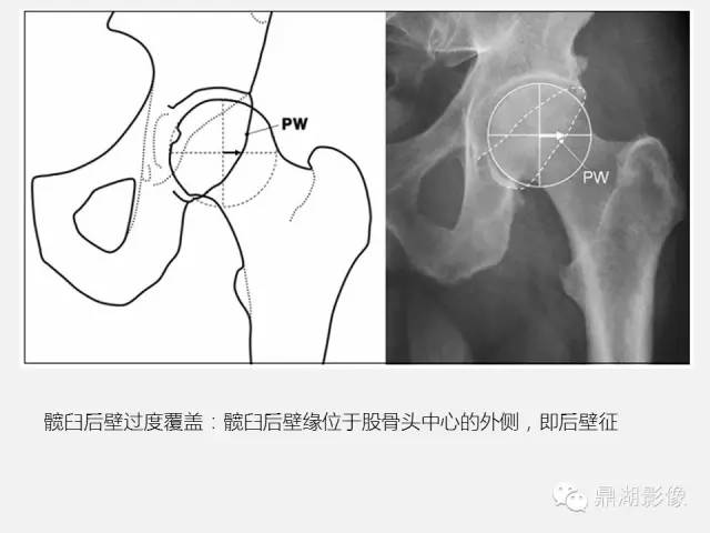 【PPT】髋关节撞击综合症