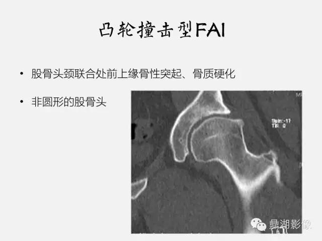 【PPT】髋关节撞击综合症