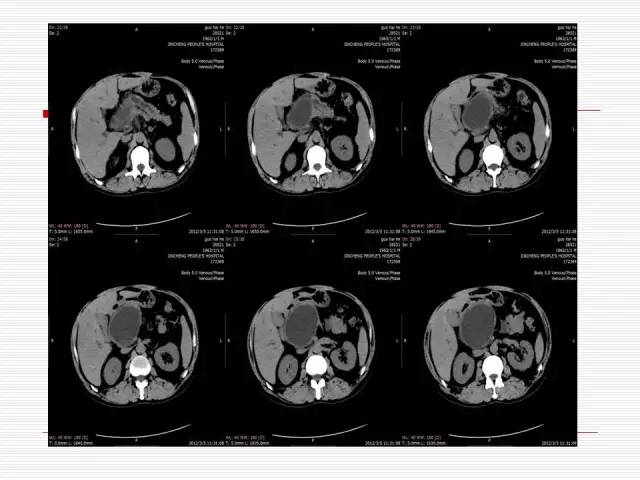 【病例】胰腺囊性病变6例CT影像表现与鉴别 【病例】胰腺囊性病变6例CT影像表现与鉴别