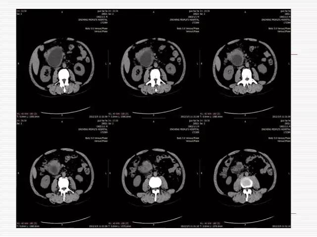 【病例】胰腺囊性病变6例CT影像表现与鉴别 【病例】胰腺囊性病变6例CT影像表现与鉴别
