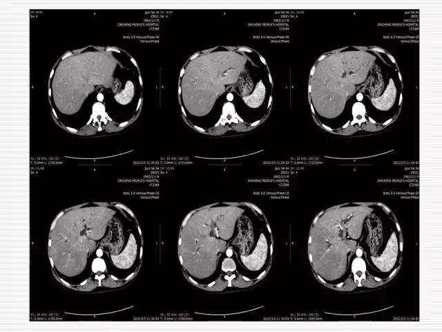 【病例】胰腺囊性病变6例CT影像表现与鉴别 【病例】胰腺囊性病变6例CT影像表现与鉴别