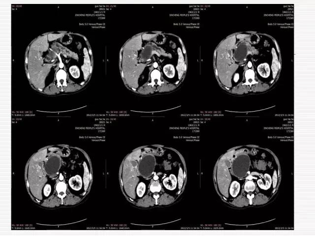 【病例】胰腺囊性病变6例CT影像表现与鉴别 【病例】胰腺囊性病变6例CT影像表现与鉴别