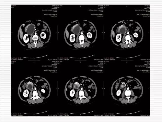 【病例】胰腺囊性病变6例CT影像表现与鉴别 【病例】胰腺囊性病变6例CT影像表现与鉴别