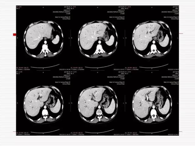 【病例】胰腺囊性病变6例CT影像表现与鉴别 【病例】胰腺囊性病变6例CT影像表现与鉴别