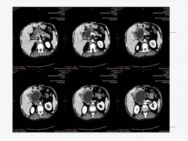 【病例】胰腺囊性病变6例CT影像表现与鉴别 【病例】胰腺囊性病变6例CT影像表现与鉴别