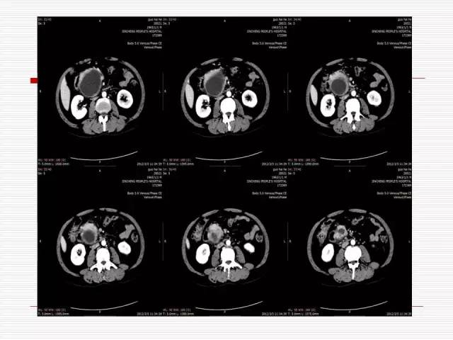 【病例】胰腺囊性病变6例CT影像表现与鉴别 【病例】胰腺囊性病变6例CT影像表现与鉴别