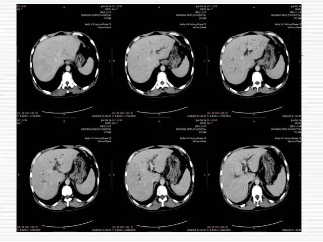 【病例】胰腺囊性病变6例CT影像表现与鉴别 【病例】胰腺囊性病变6例CT影像表现与鉴别