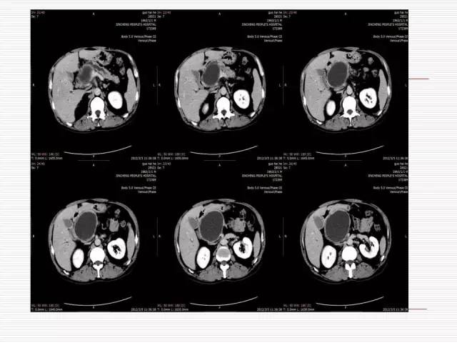【病例】胰腺囊性病变6例CT影像表现与鉴别 【病例】胰腺囊性病变6例CT影像表现与鉴别