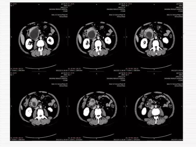 【病例】胰腺囊性病变6例CT影像表现与鉴别 【病例】胰腺囊性病变6例CT影像表现与鉴别