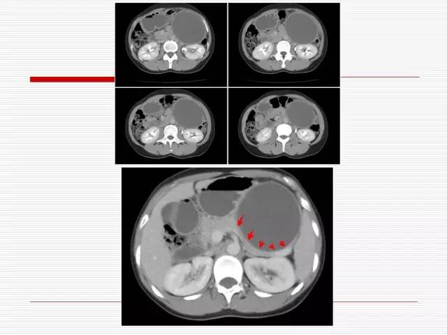 【病例】胰腺囊性病变6例CT影像表现与鉴别 【病例】胰腺囊性病变6例CT影像表现与鉴别