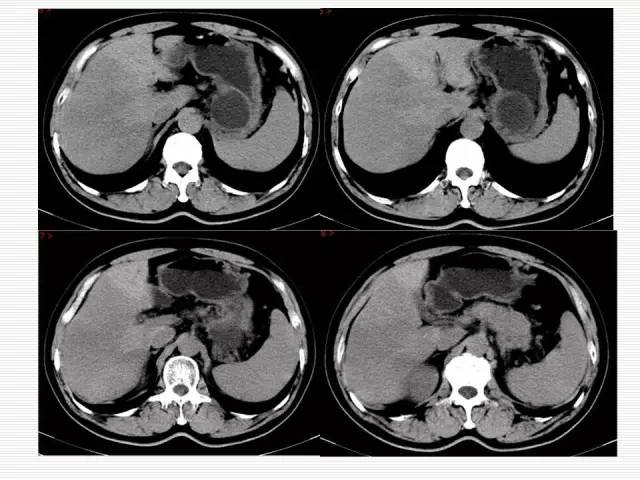 【病例】胰腺囊性病变6例CT影像表现与鉴别 【病例】胰腺囊性病变6例CT影像表现与鉴别