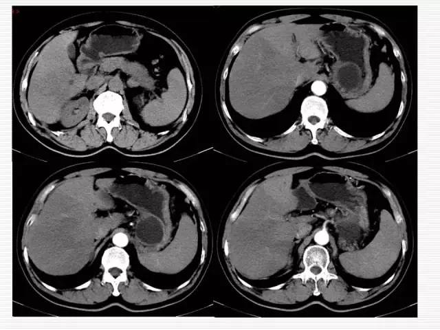 【病例】胰腺囊性病变6例CT影像表现与鉴别 【病例】胰腺囊性病变6例CT影像表现与鉴别