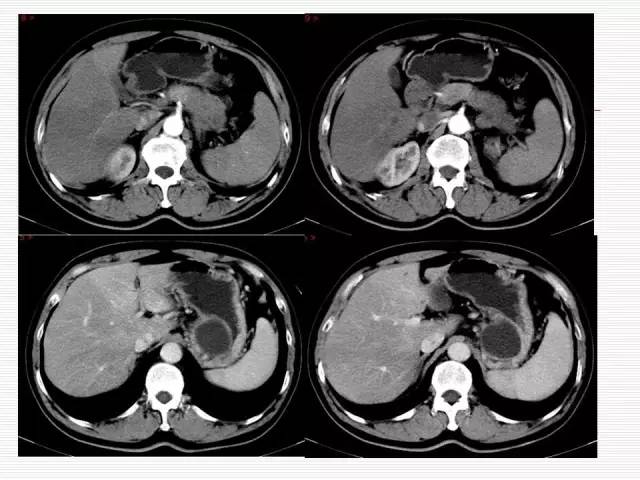 【病例】胰腺囊性病变6例CT影像表现与鉴别 【病例】胰腺囊性病变6例CT影像表现与鉴别